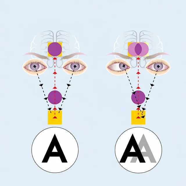 diplopia